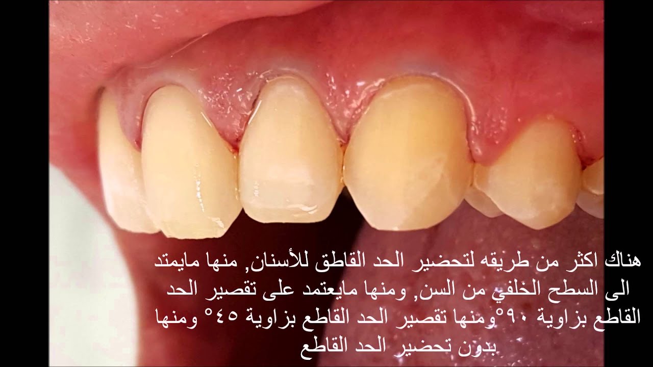 طريقة تحضيرالفينير(د. احمد موسى جابر) veneers preparation