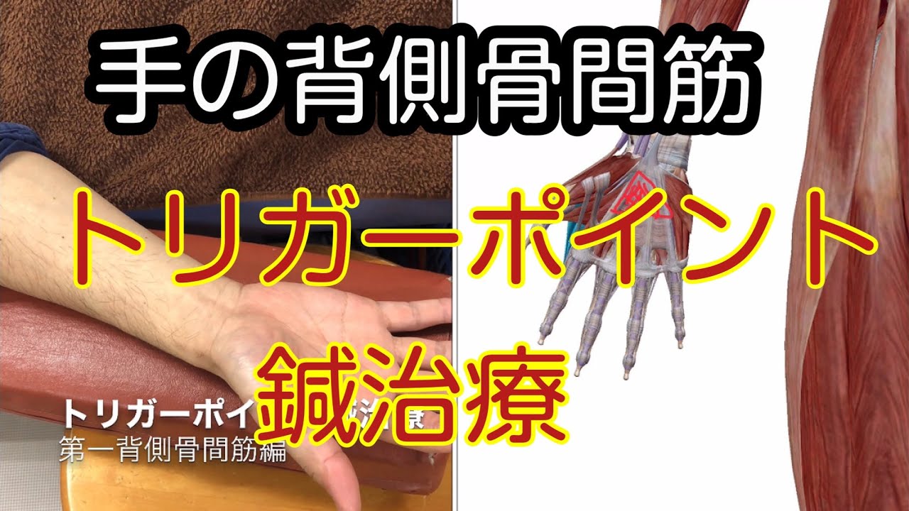 指の背側骨間筋のトリガーポイント鍼治療　trigger point