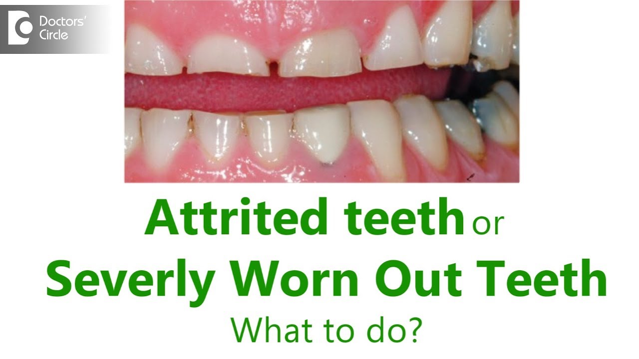 Full mouth rehabilitation of severely attrited teeth - Dr. Ranjani Rao