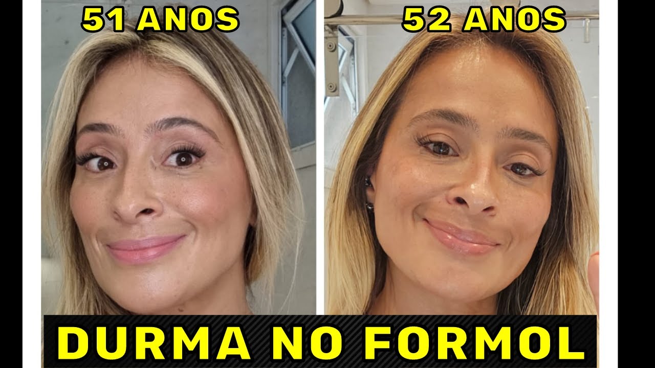USEI Retinol, Vitacid e Vitanol o Ano Inteiro! Veja o que Aconteceu!