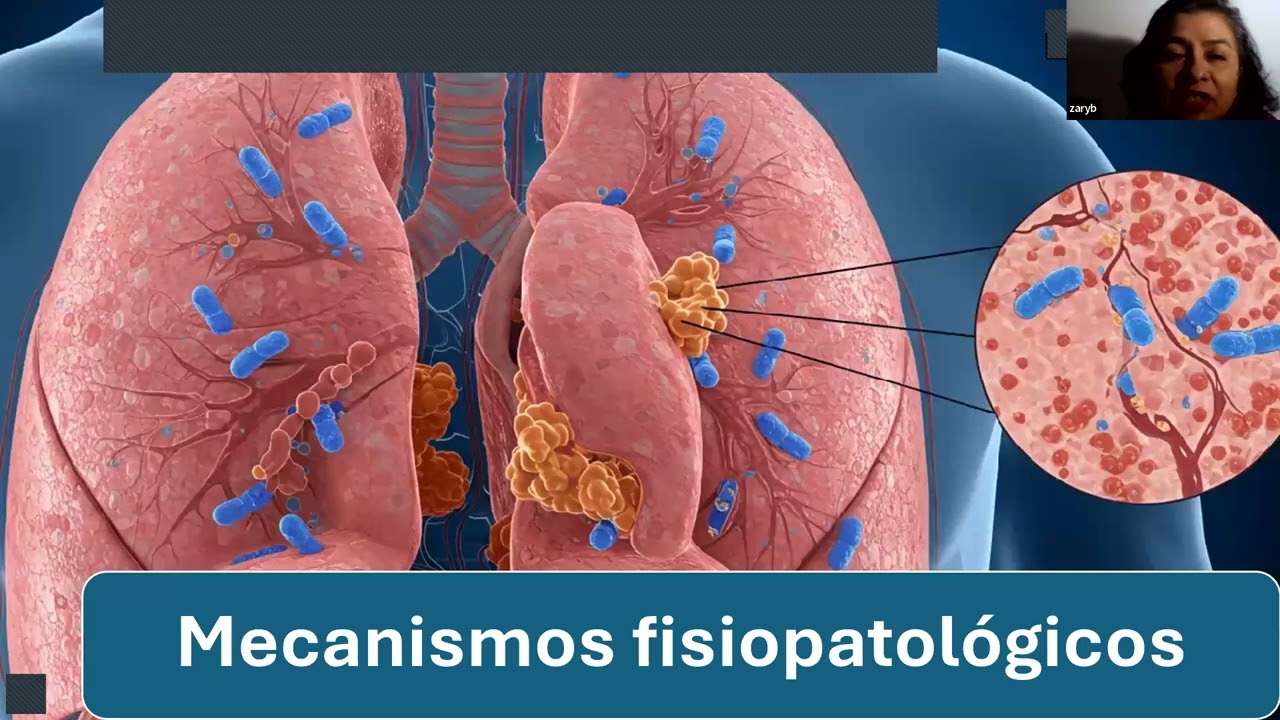 diabetes y neumonía bacteriana