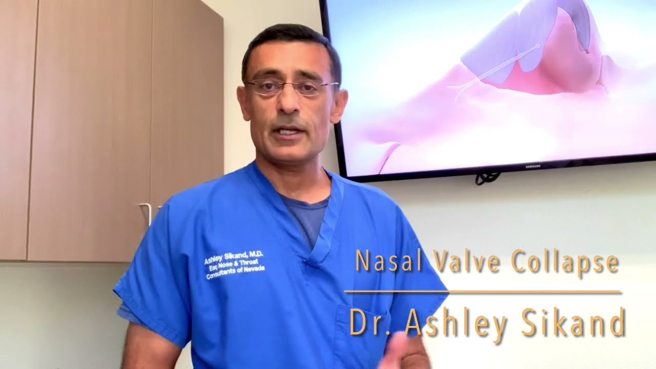 Nasal Valve Collapse