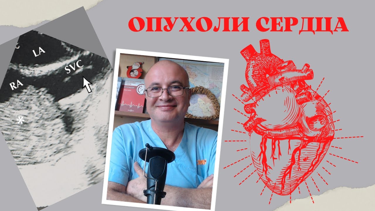 Опухоли сердца. Миксома и другие новообразования