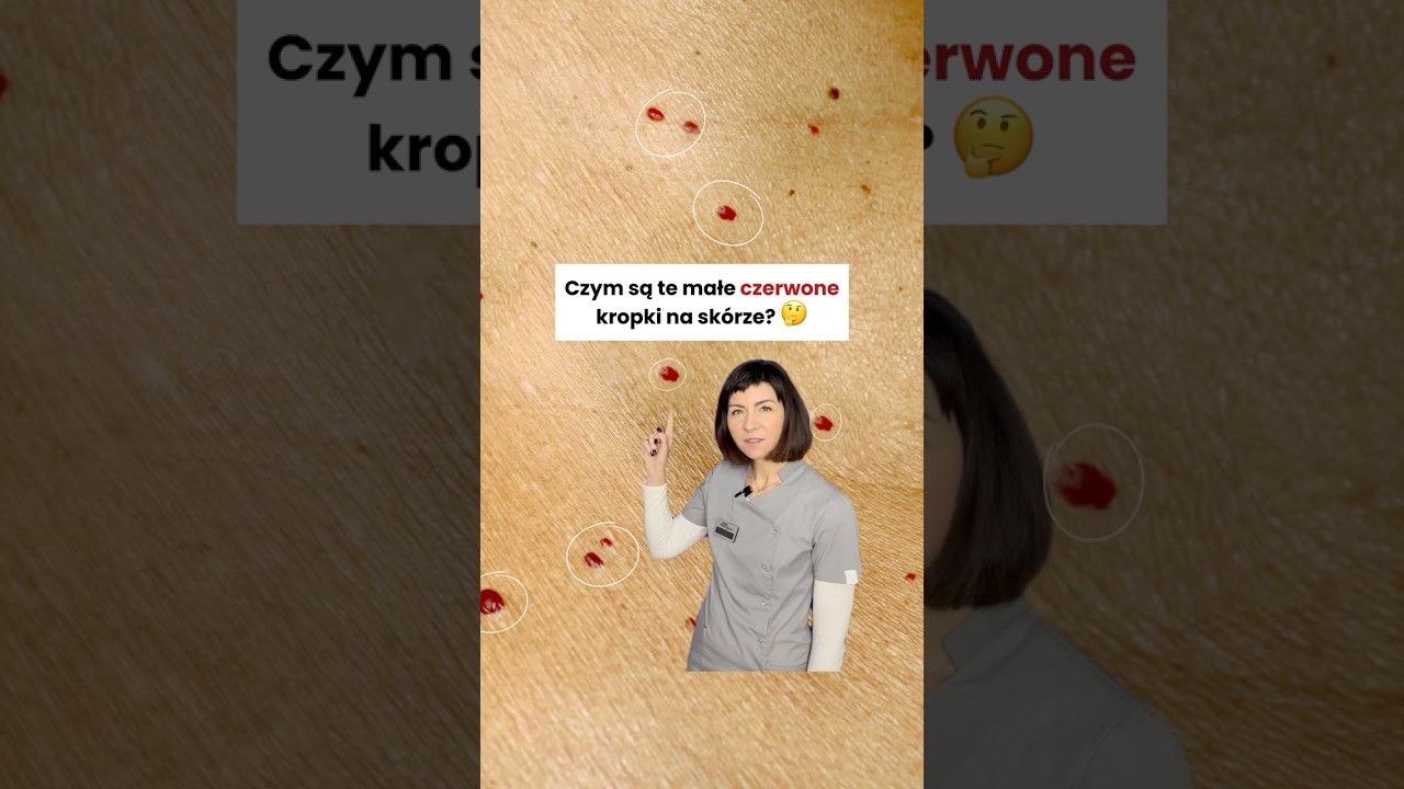 🚨 CZERWONE KROPKI NA SK&Oacute;RZE? TO TYLKO NACZYNIAKI RUBINOWE