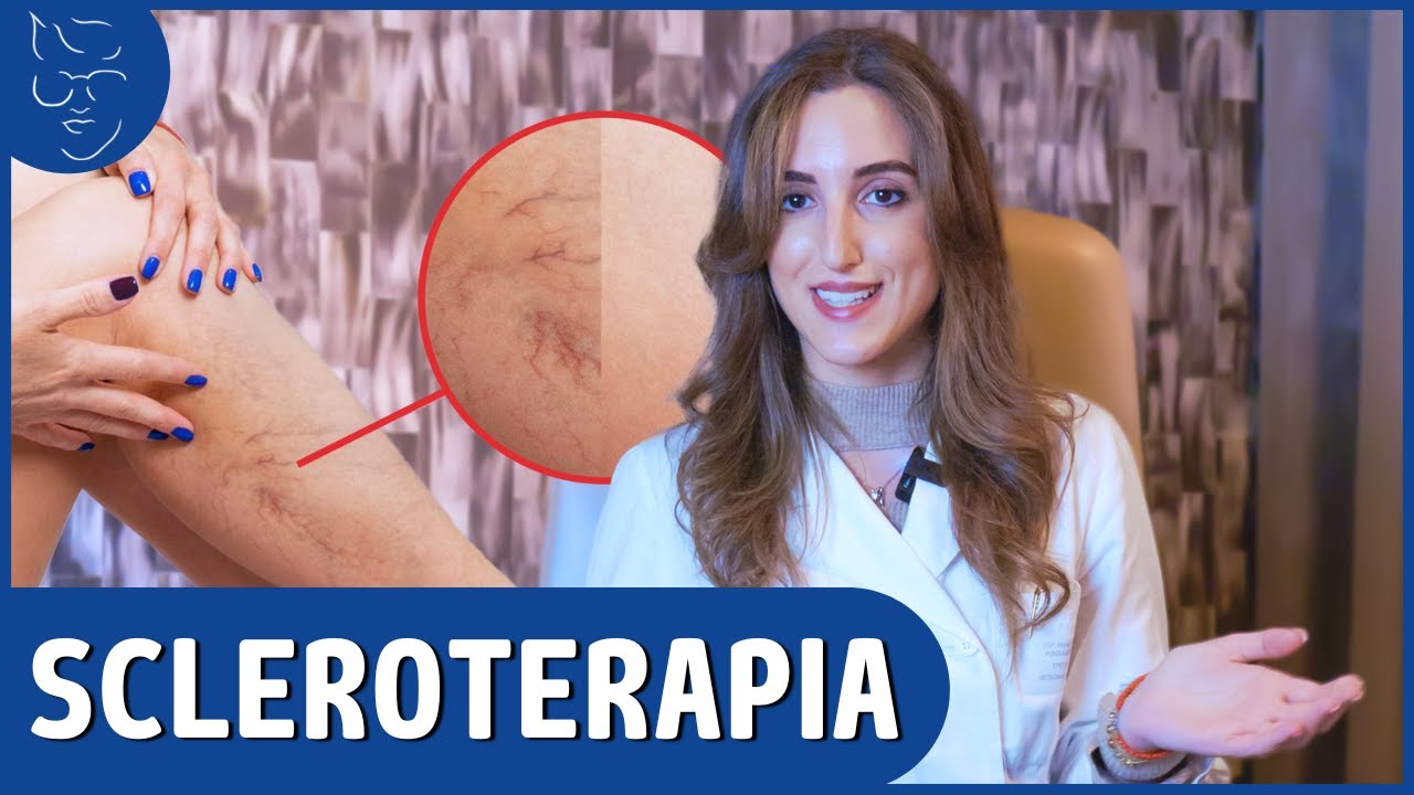 SCLEROTERAPIA: 