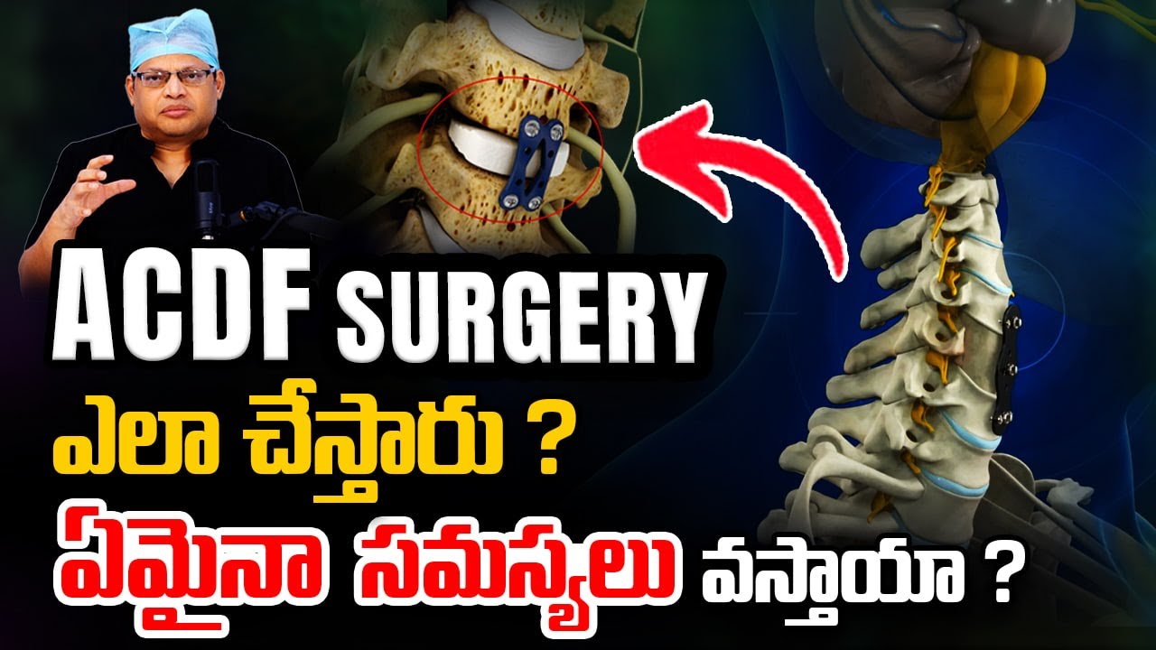 ACDF శస్త్రచికిత్స | ప్రమాదాలు & రికవరీ | Complications of ACDF surgery in telugu | Dr GPV Subbaiah