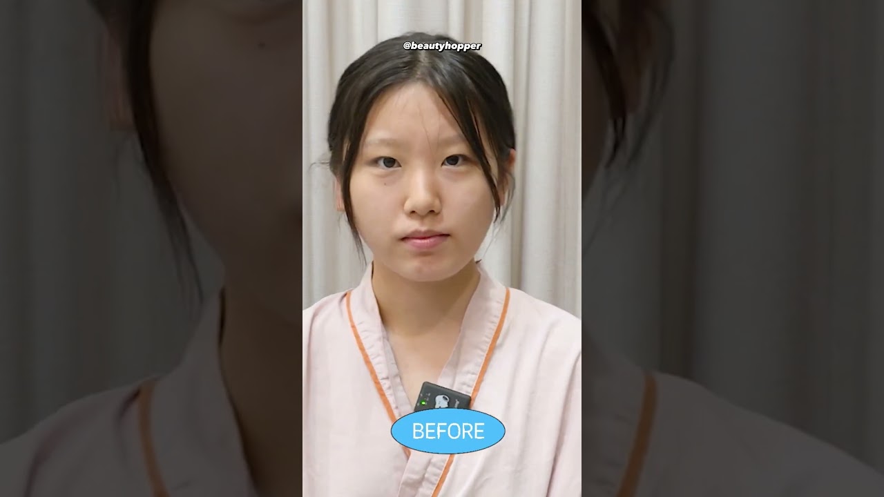 plastic surgery before and after in korea 😍