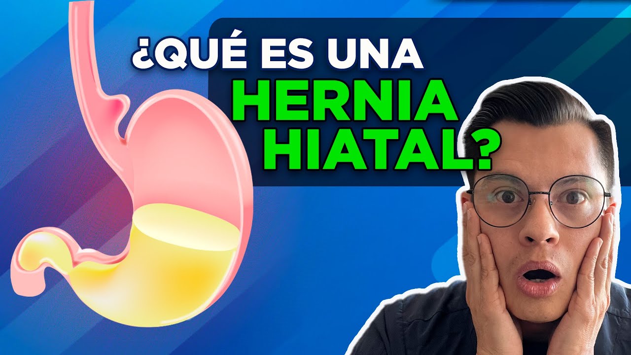 ¿QUÉ ES UNA HERNIA HIATAL?