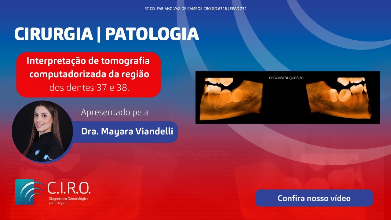 Interpreta&ccedil;&atilde;o de tomografia computadorizada da regi&atilde;o dos dentes 37 e 38 com a Dra. Mayara Viandelli