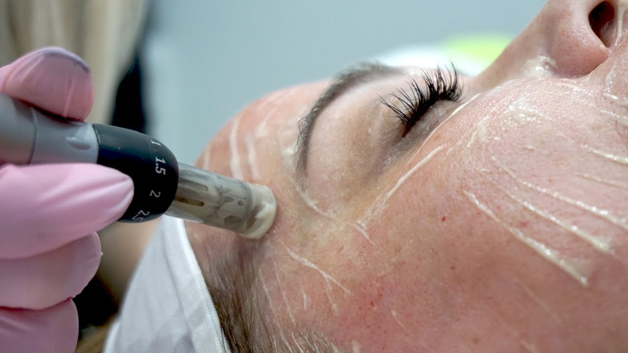 Microneedling