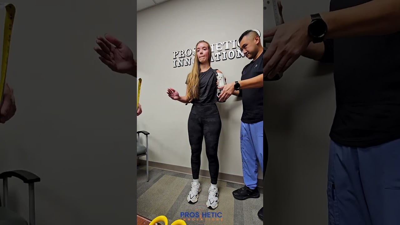 Trans-Humeral Myo-Electric Elbow and Wrist placement | Prosthetic Innovations