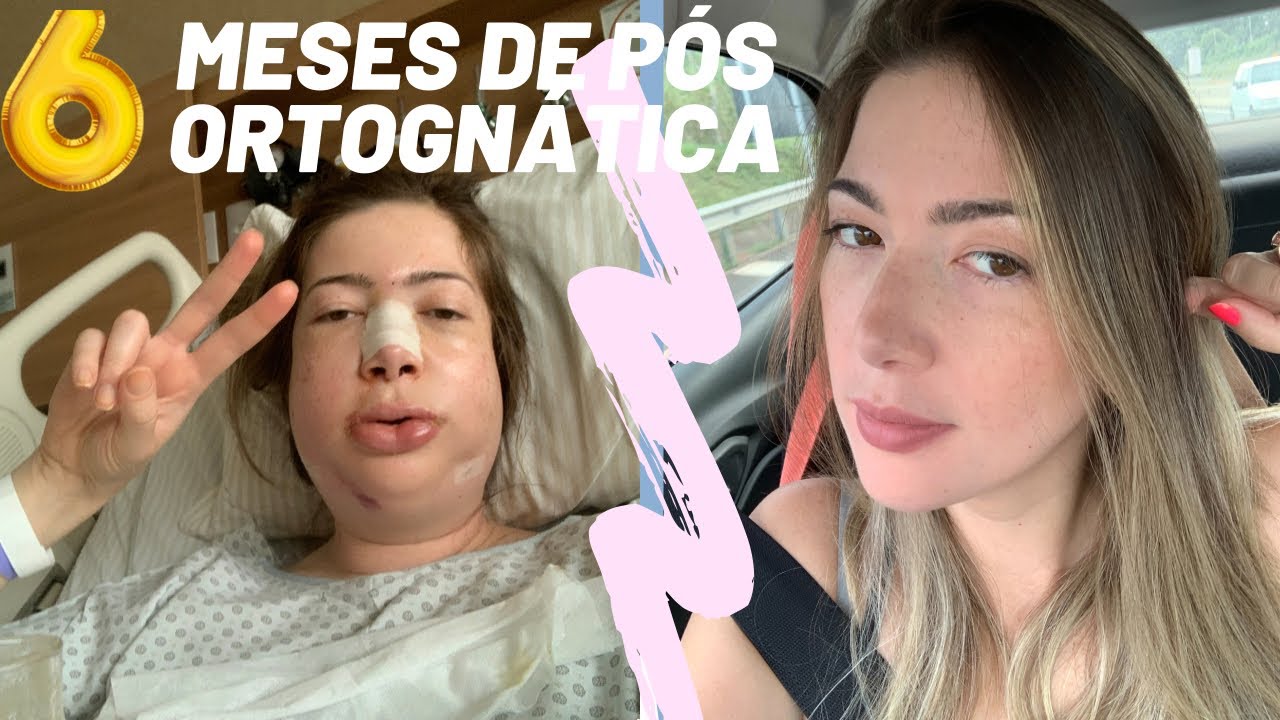 Ortognática Classe 2 - Pós operatório 6 meses!!!