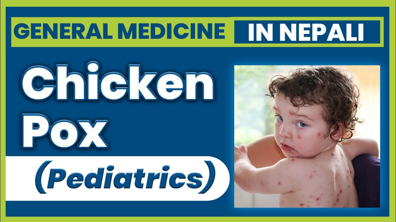 Chicken Pox in Nepali | General Medicine | Viral disease