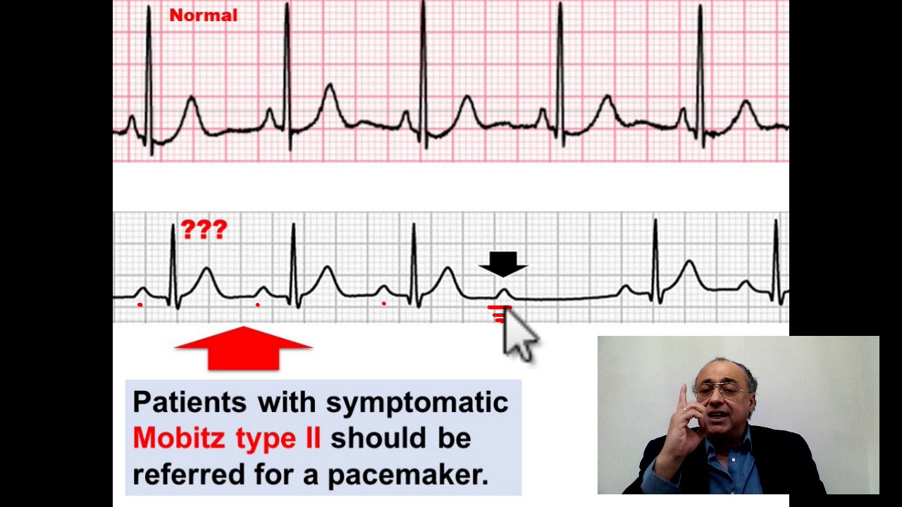 Mobitz type II AV Block #cme #internal_medicine #pharmaceutical #medical #doctor   #محاضرات_باطنة