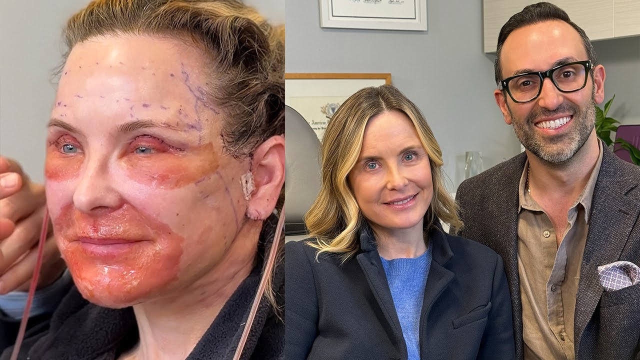 Two Months After Deep Plane Face & Neck Lift with Dr. Kian