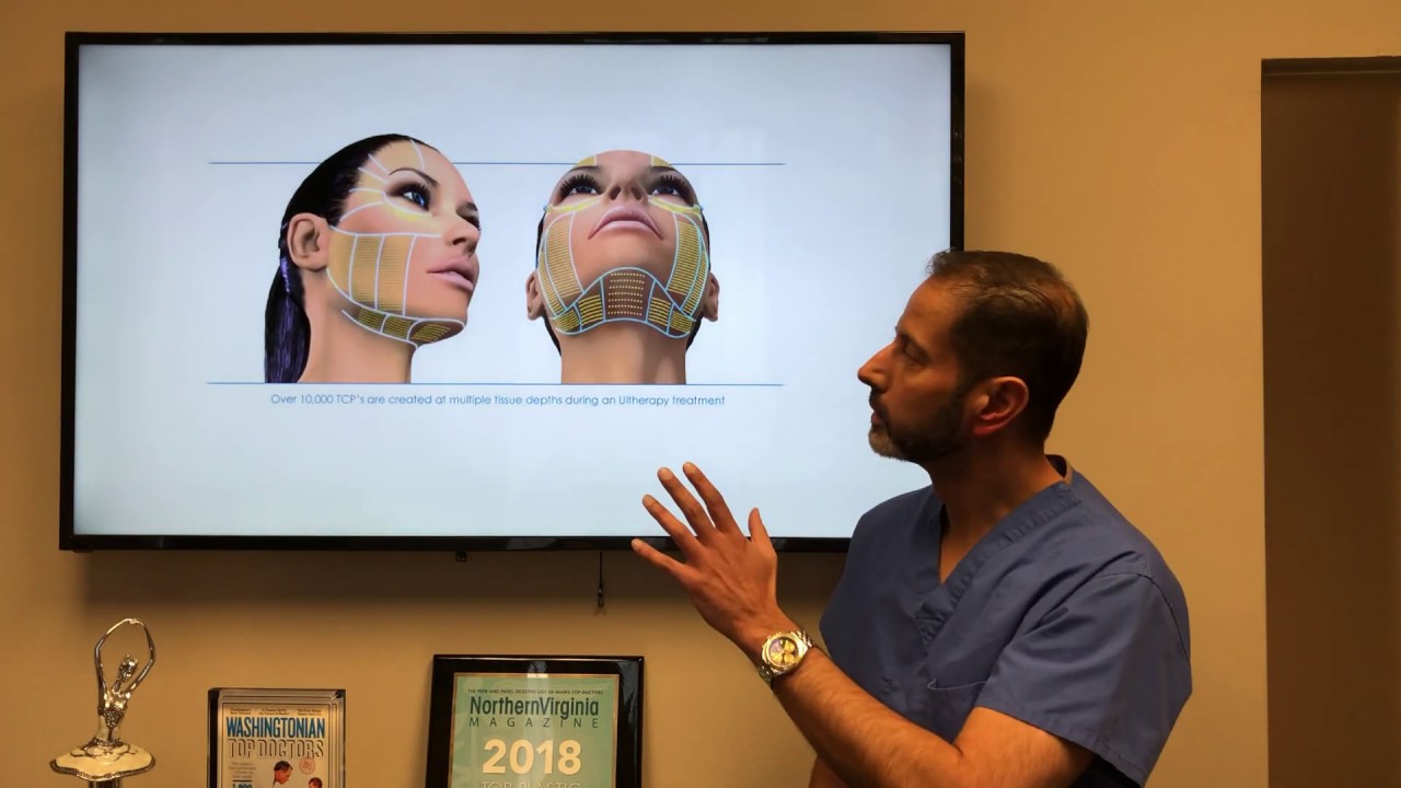 Double Chin/Neck Improvement - Difference Between Ultherapy, Kybella, Liposuction and Necklift