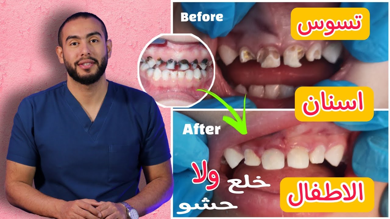 تسوس اسنان الاطفال الاسباب والعلاج | لو اسنان طفلك سوده ومتكسره تعملى ايه ؟! حشو ولا خلع 🤔