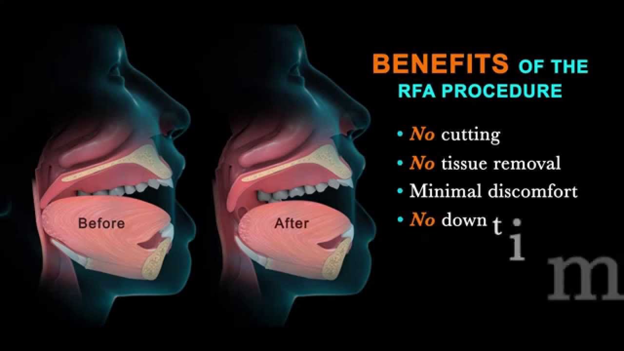 Treating Sleep Apnea with the RFA Procedure