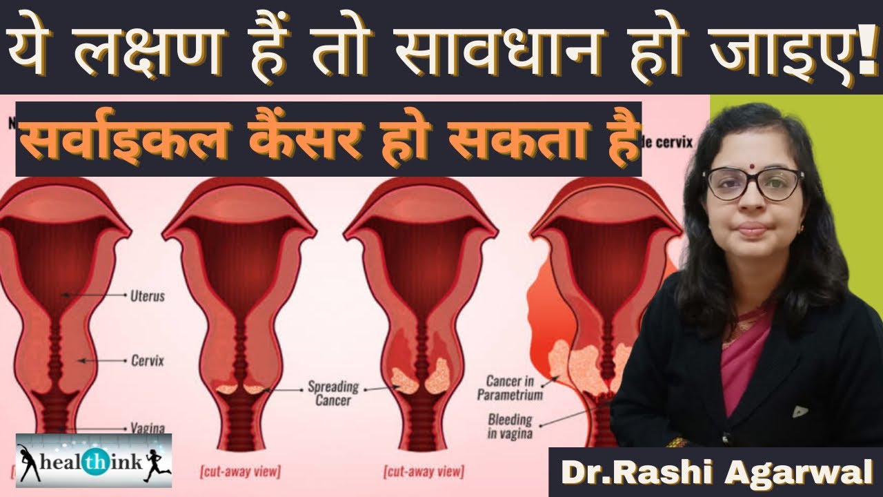 सर्वाइकल कैंसर के शुरुआती लक्षण और उसका इलाज।Early symptoms & treatment of Cervical cancer।Healthink