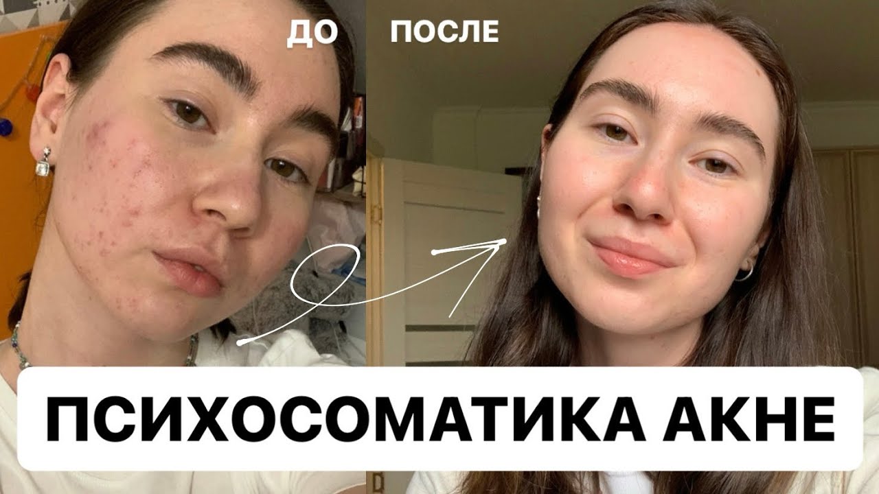 Психосоматика АКНЕ | личный опыт