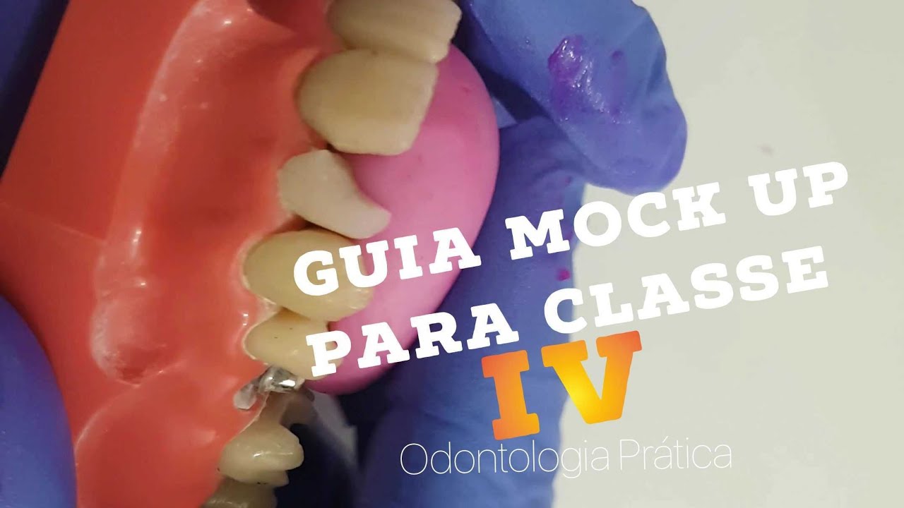 🛑✍ Guia muralha palatina modificada para classe IV , III e facetas!!! MOCK UP PRÁTICO!!!🤫