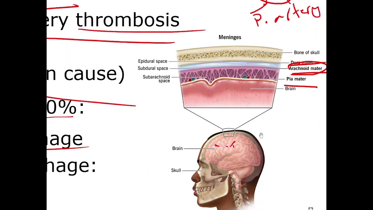 Adult Health Nursing 2: Neurologic Dysfunctions - Cerebrovascular Accident (CVA) - Ischemic Stroke