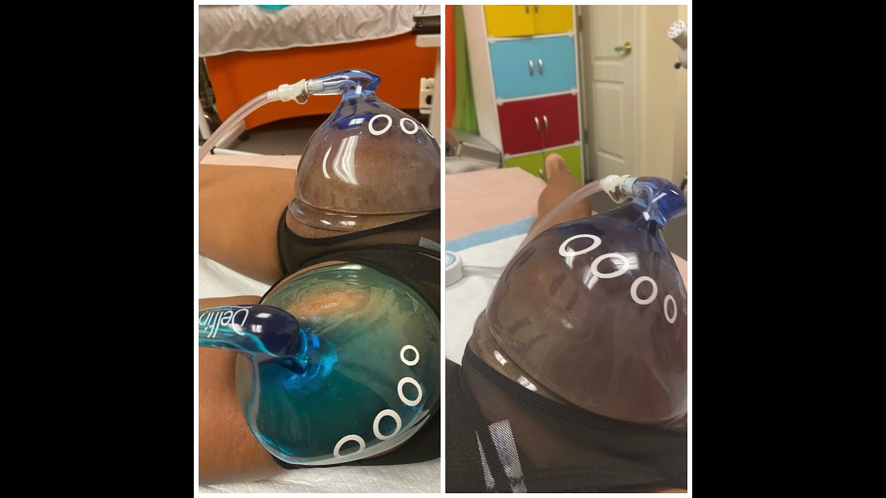 Vacuum Therapy Butt Enhancement