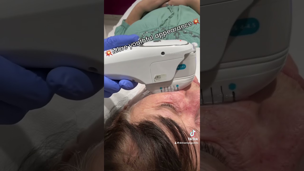 HIFU treatment