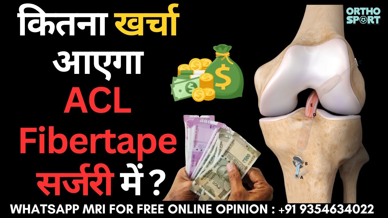 कितना खर्चा आएगा ACL Fibertape Internal Brace सर्जरी में ? Cost of ACL Fibertape Surgery in India