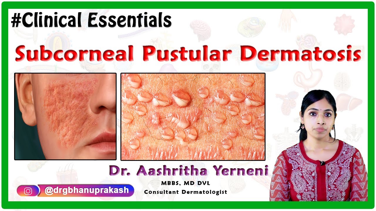 Subcorneal Pustular Dermatosis ( Clinical Essentials ) : Dr. Aashritha yerneni