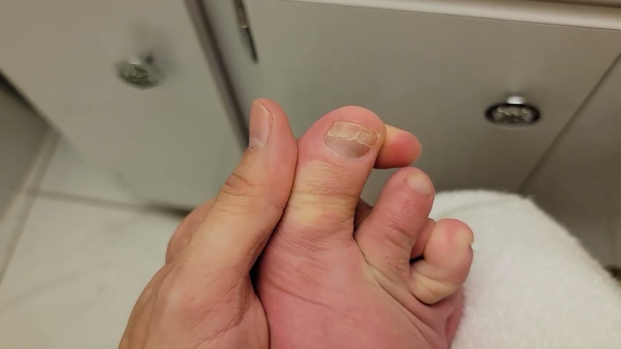 I'm Getting Two New Toenails On My Big Toes! (Wheelchair user) (Paraplegic)