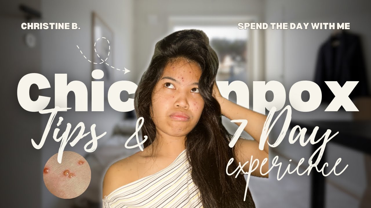 Things I Wish I Knew Before Having Chickenpox | Symptoms, Remedies, Do’s & Don’ts (Day 7 Experience)