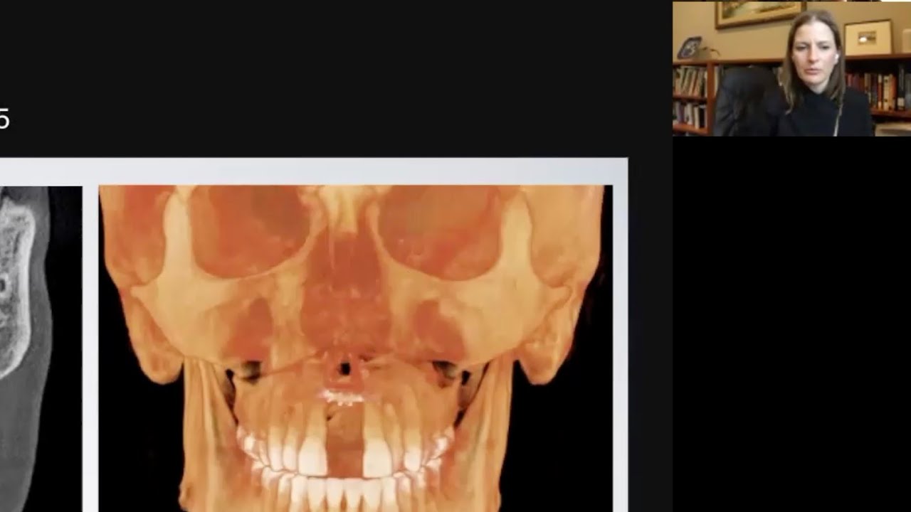 Dr. Bockow on MSE Asymmetry, Surgical Assist and Cheekbones