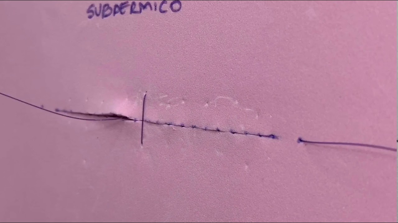 Punto Subdérmico (Subcuticular)