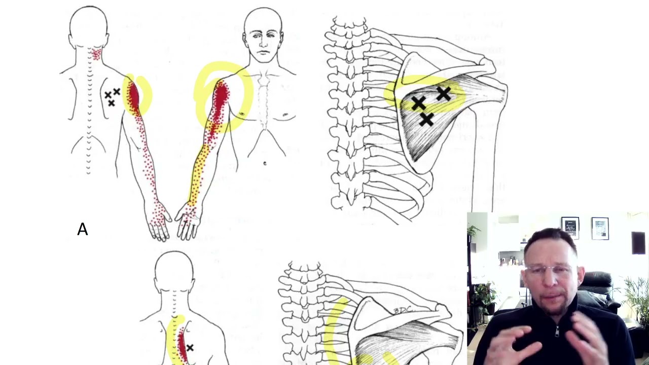Triggerpisteet | Osa 14 | Alempi lapalihas, infraspinatus.