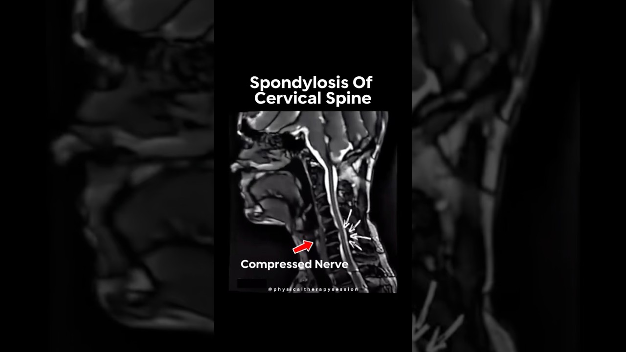 Cervical Spondylosis Stretch!  #spondylosis #neckpain #physio