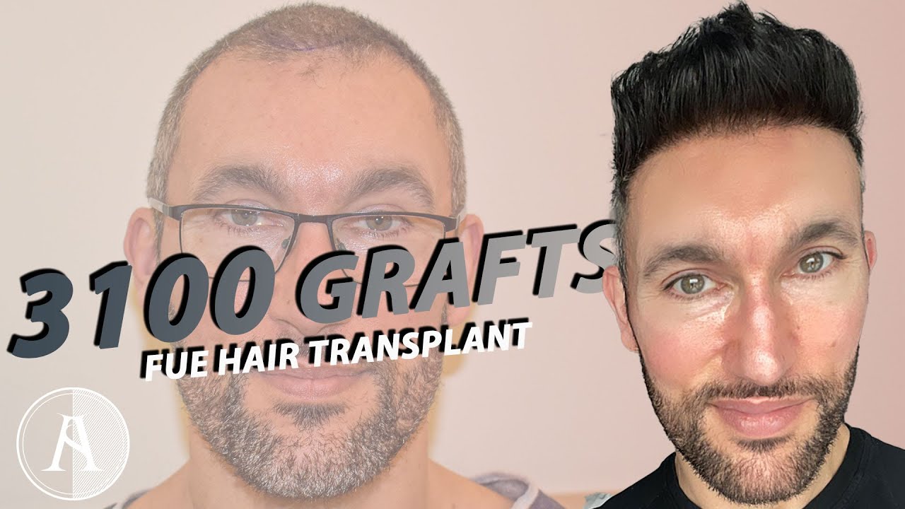 Hair Transplant Evolution / 3100 Grafts FUE | Injerto Capilar Evolucion / FUE 3100 Foliculos