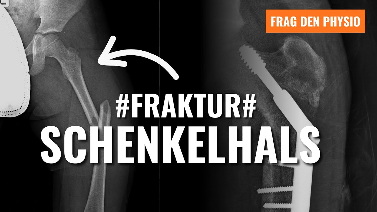 Schenkelhalsfraktur und steife Hüfte. Was war nochmal die Frage?
