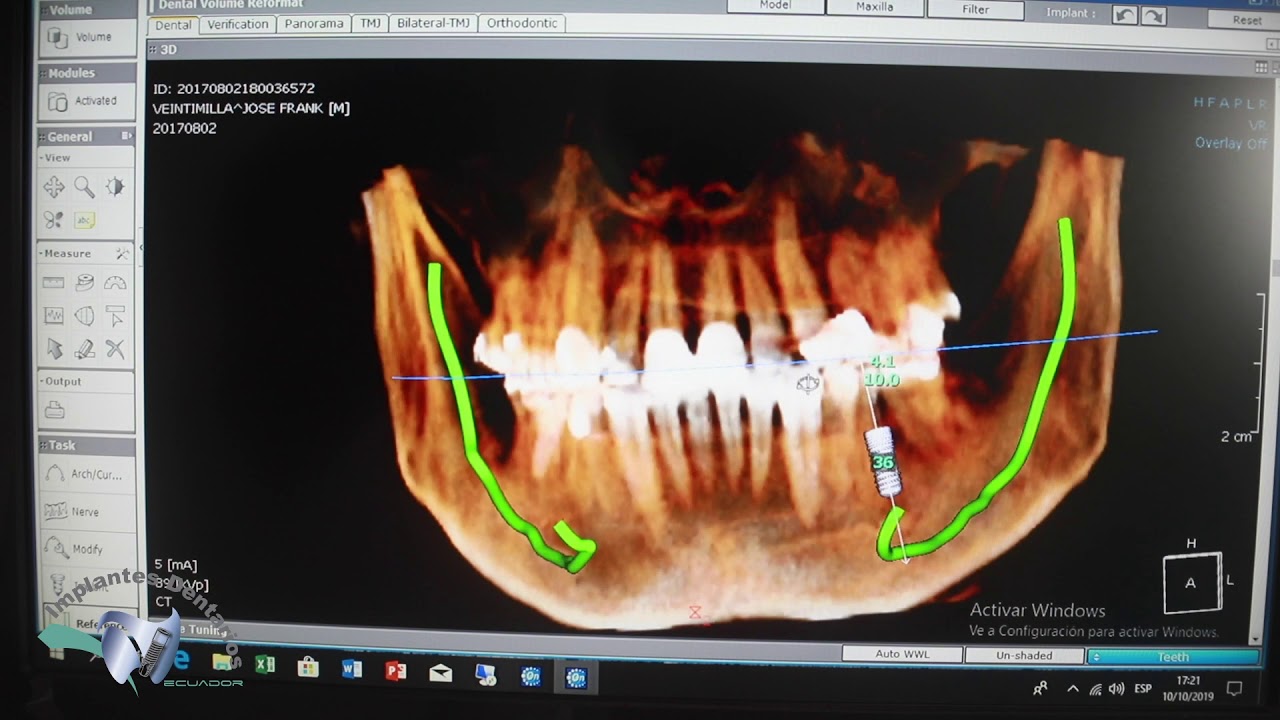 Pasos para un Implante Dental : Tomografía.