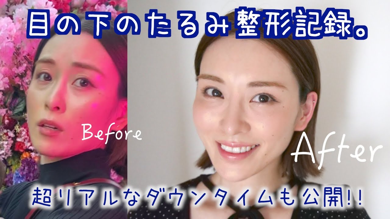 目の下、限界だったので整形しました。【裏ハムラ法】