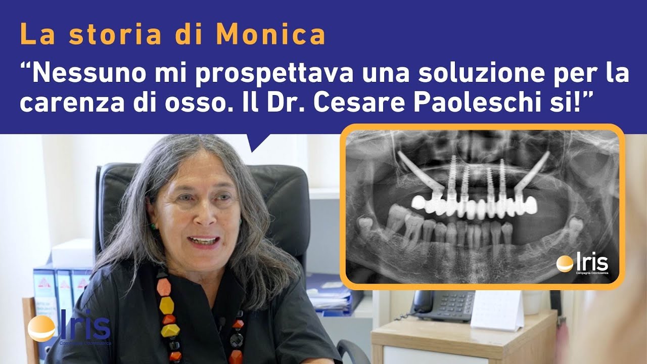 IMPIANTI DENTALI FISSI SENZA OSSO: La Storia di Monica