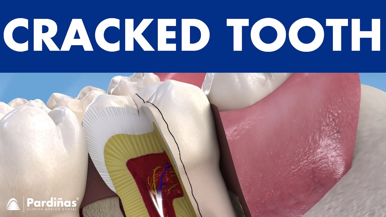 Chipped and CRACKED TOOTH  - How do teeth break? ©
