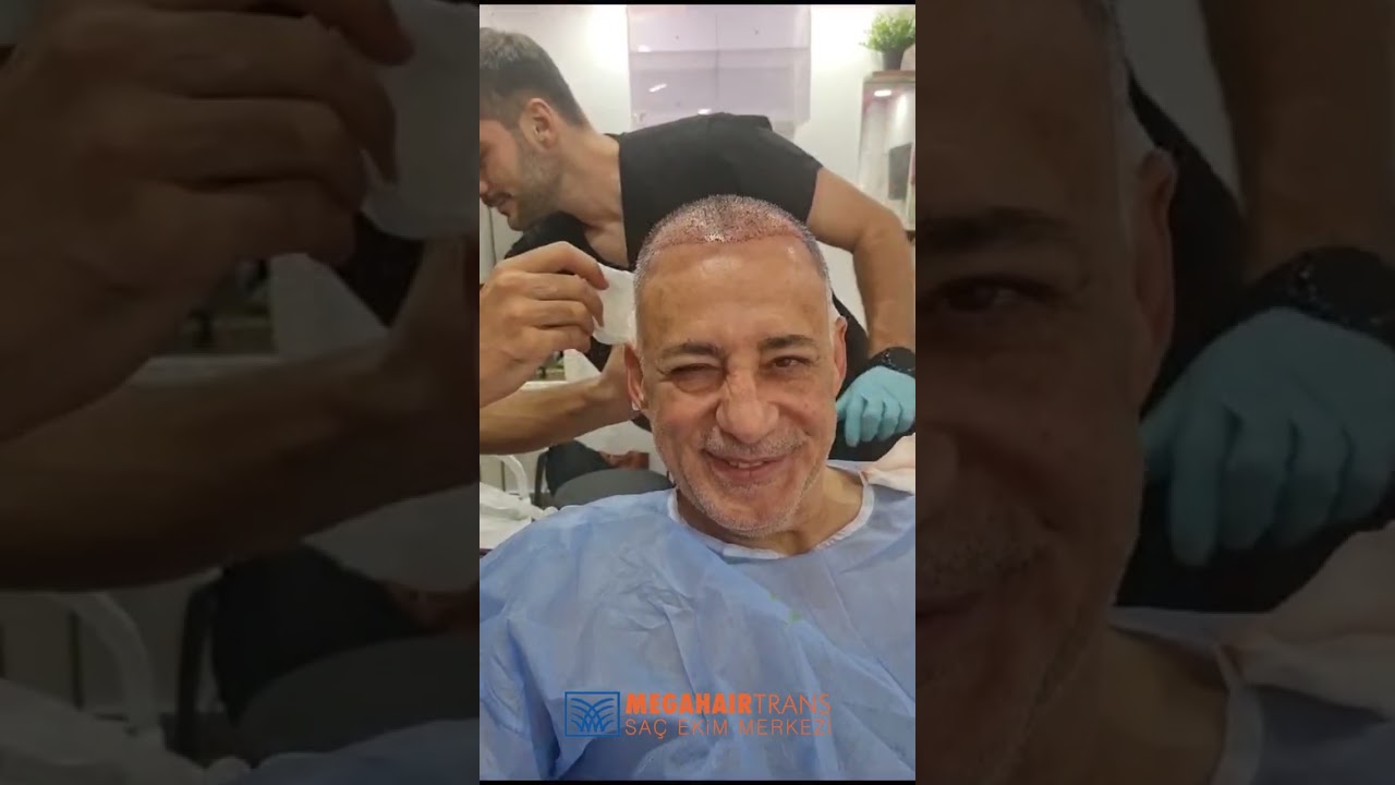İzmirden Gelen Hastamıza Ağrısız ve Acısız DHI Tekniği ile Saç Ekimi Gerçekleştirdik.