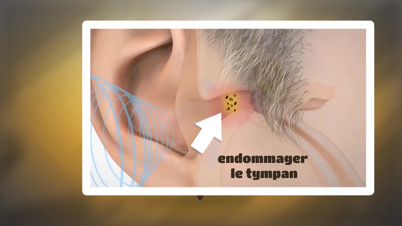 2mn pour comprendre le bouchon d'oreille