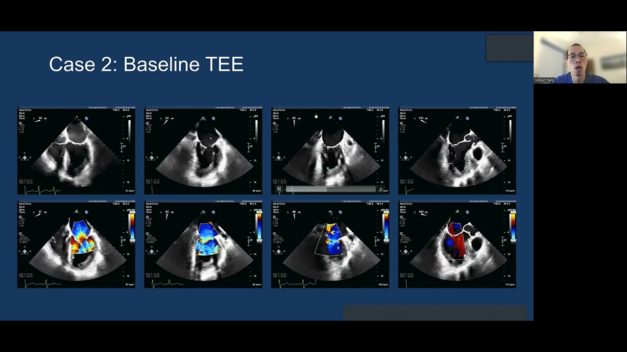 2022: Transcatheter Mitral Valve Replacement (TMVR): the Medtronic Intrepid system