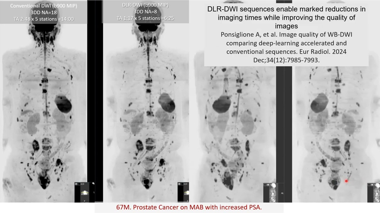 WB-MRI for Prostate Cancer - NotebookLM Discussion