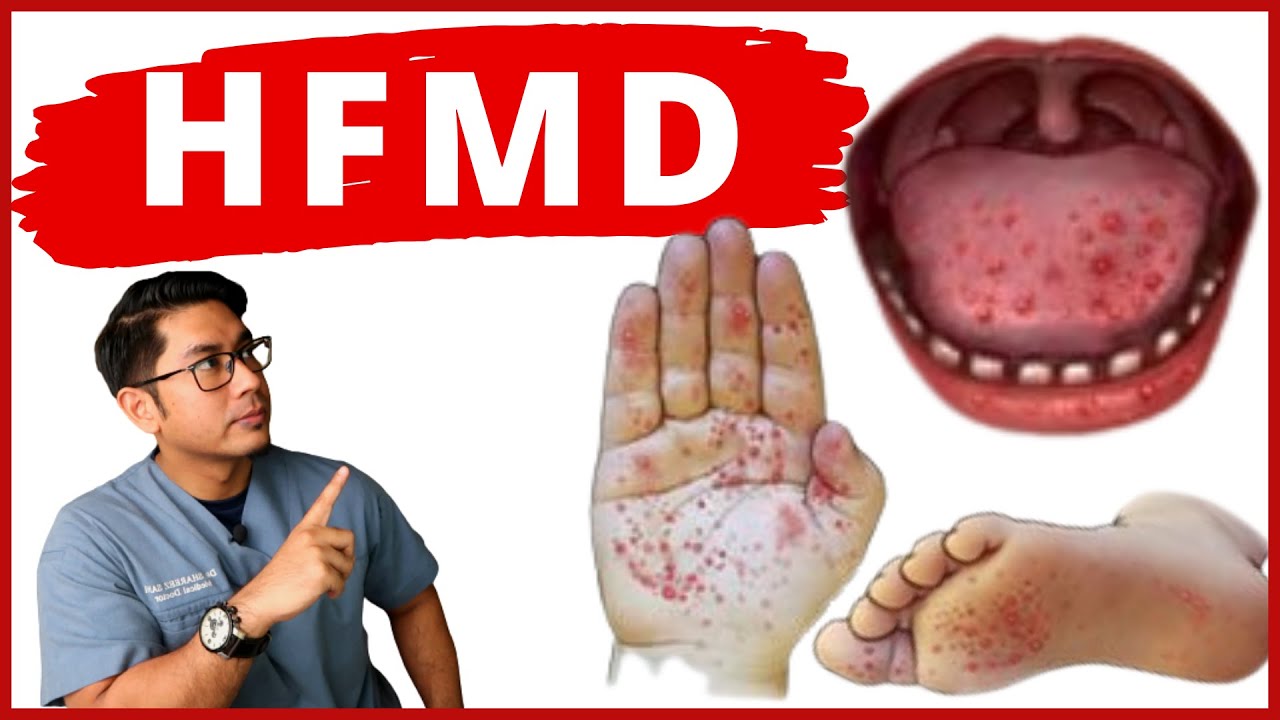 Tanda Awal HFMD | Penyakit Tangan Kaki & Mulut | Doctor Sani |