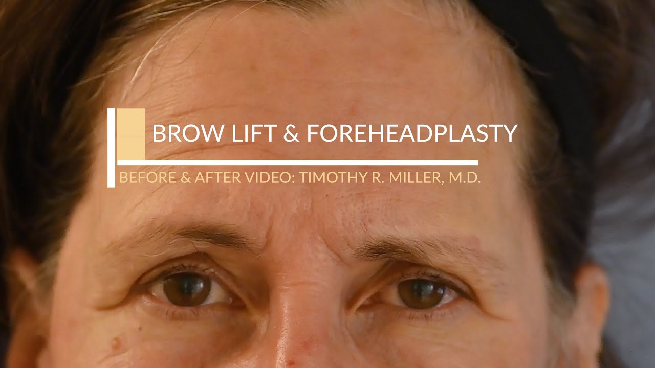 Brow Lift and Foreheadplasty