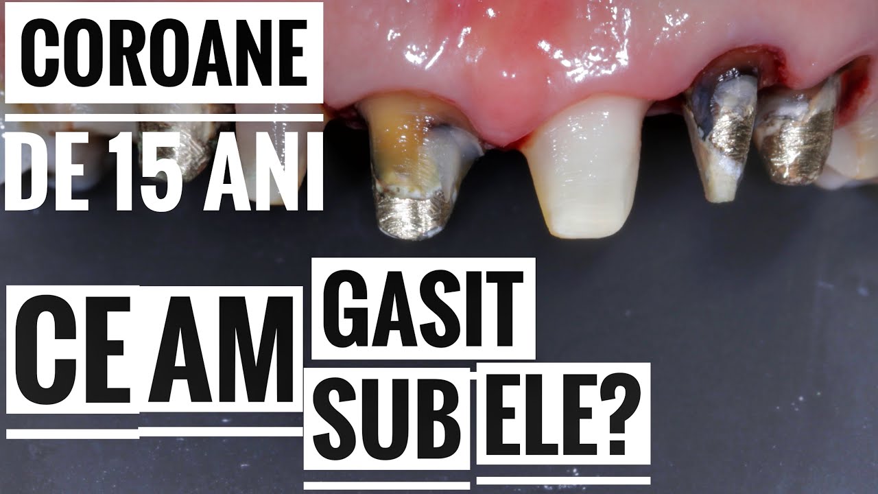 Am Taiat Coroane Dentare Vechi De 15 Ani, Ce Am Gasit Dedesubt? Metal Sau Zirconiu?