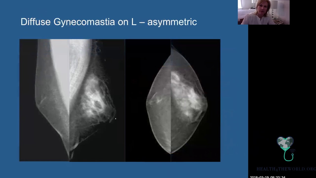 Imaging of the Male Breast - Part 2 | Health4TheWorld Academy